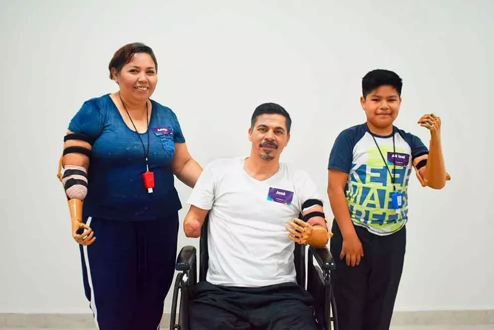 Alí, Adela y José vuelven a sonreír con su prótesis de antebrazo