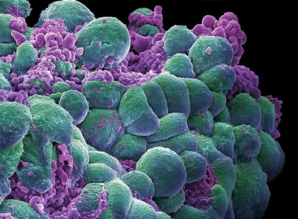 Identifican 72 nuevas regiones genéticas ligadas al cáncer de mama
