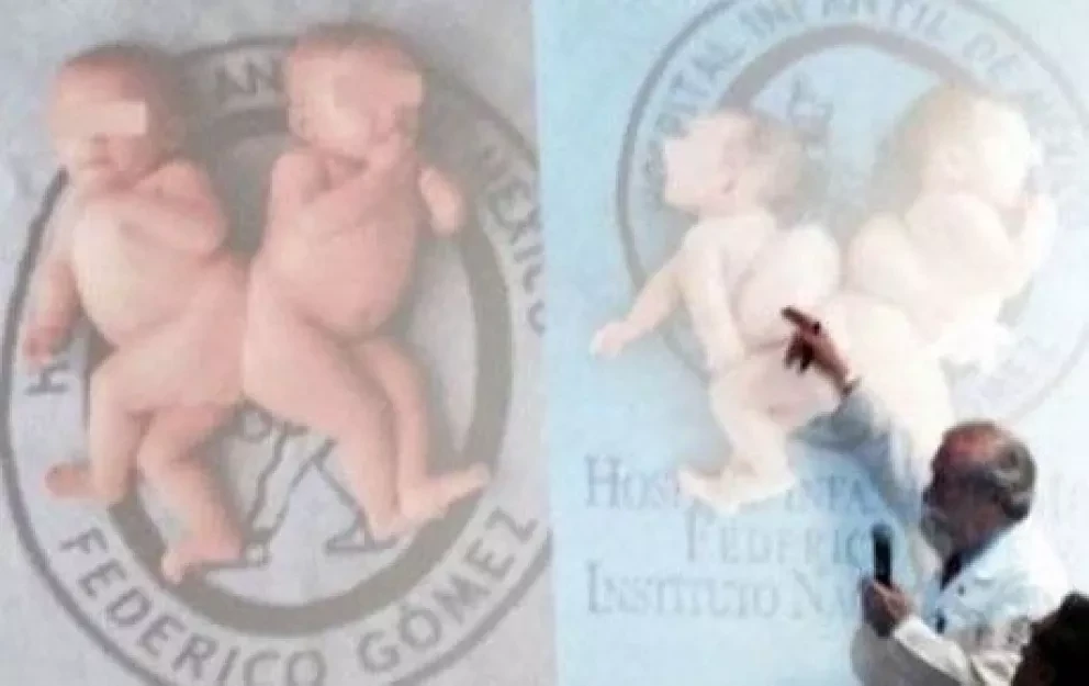Hospital Infantil de México separa con éxito a siamesas