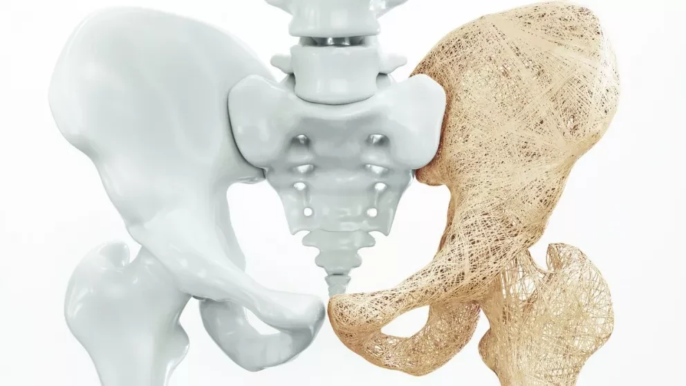 Osteoporosis: ABC de este padecimiento y el costo de una densitometría en Salud Digna