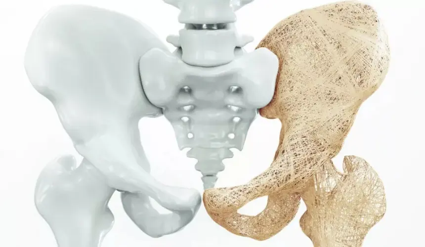 Osteoporosis: ABC de este padecimiento y el costo de una densitometría en Salud Digna 