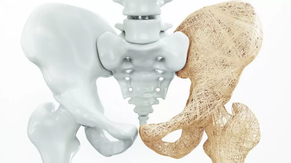 Osteoporosis: ABC de este padecimiento y el costo de una densitometría en Salud Digna 