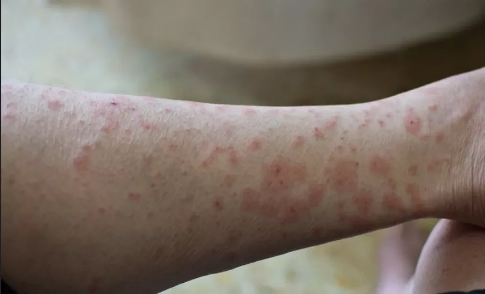 Cómo prevenir contagiarte del virus de Viruela del Mono.