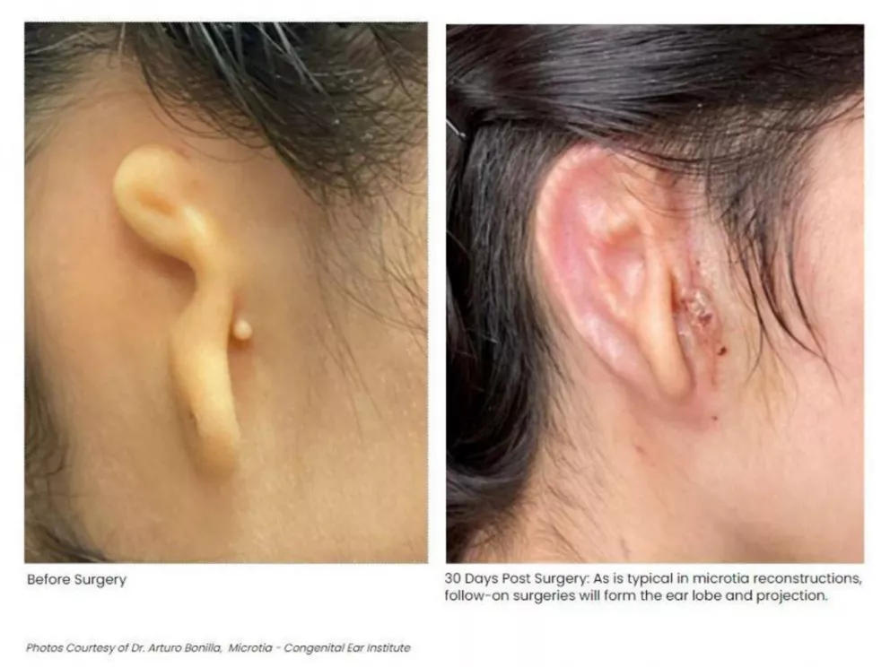 Una mexicana la primera en recibir un trasplante de oído impreso en 3D.