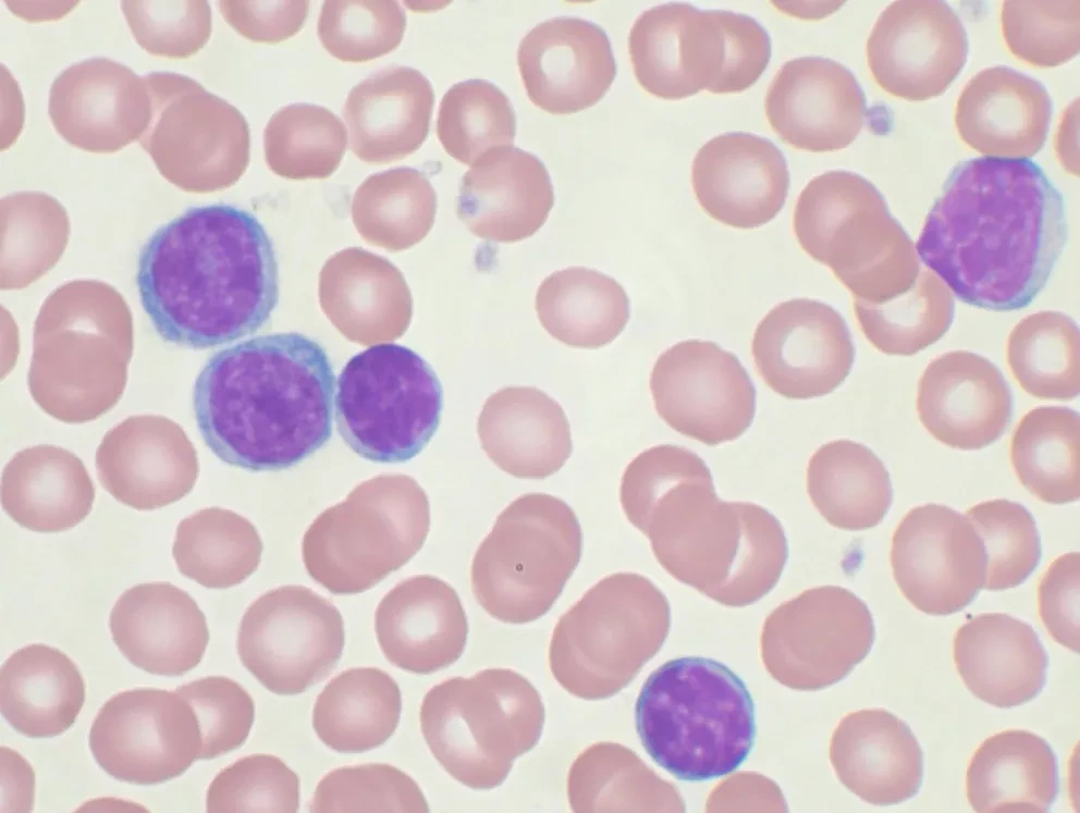 Estudio finlandés encuentra una nueva terapia para el cáncer infantil más común.