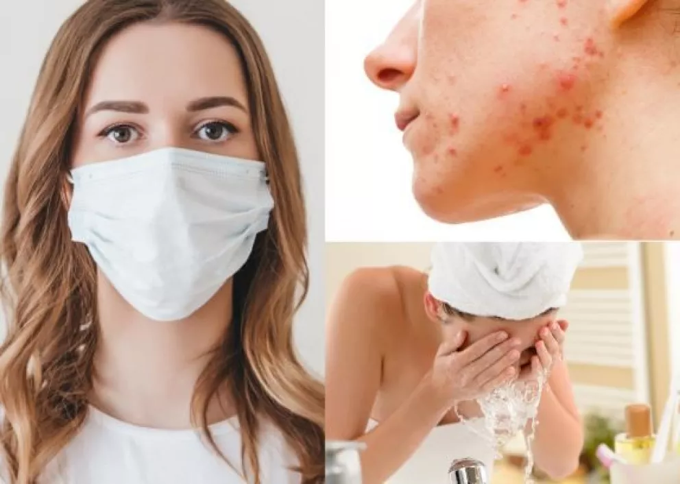 Consejos para evitar la aparición de acné por el uso de cubrebocas