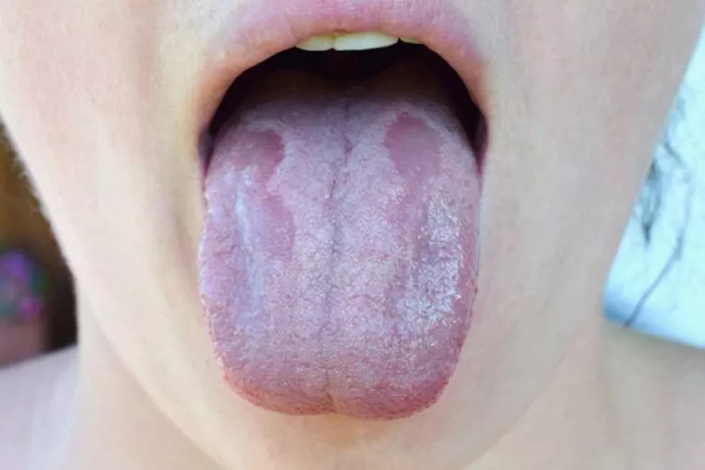 Lengua Covid: el nuevo síntoma que podría asociarse al Coronavirus