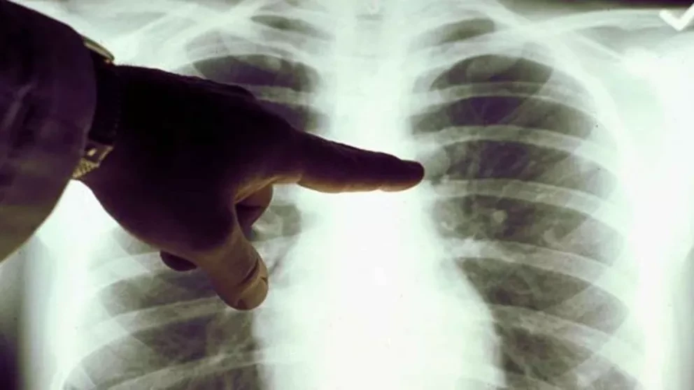 No tuve grandes dolores hasta que tosí sangre. Era cáncer de pulmón
