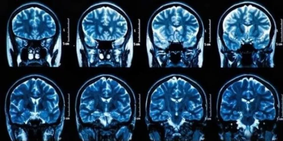 ¿El coronavirus provoca daños cerebrales?