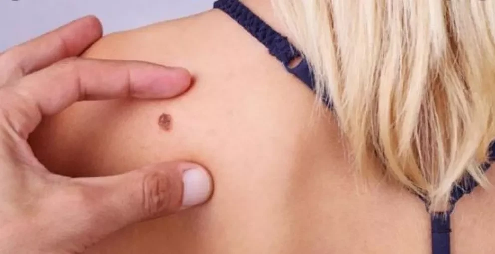 Identifica lunares cancerígenos y aprende a prevenirlos