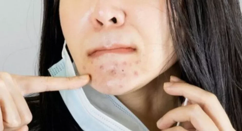 3 tips para combatir el maskne y no morir en el intento