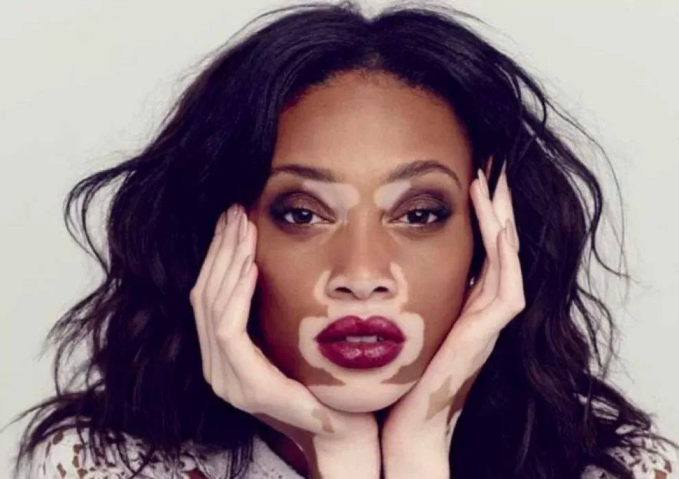 Científicos cubanos descubren cura para el vitiligo