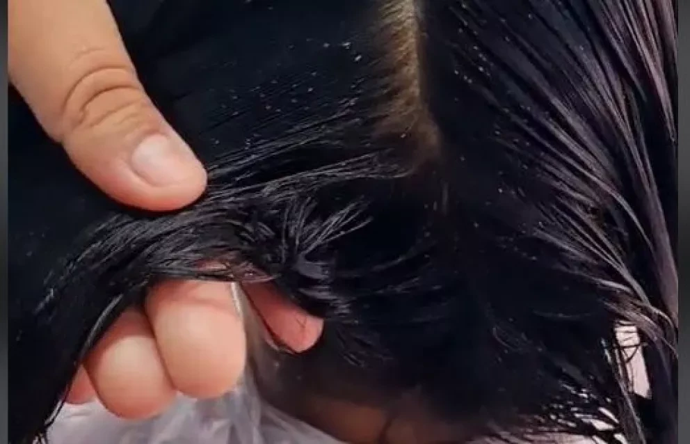Remedios caseros que no debes usar para quitar los piojos.