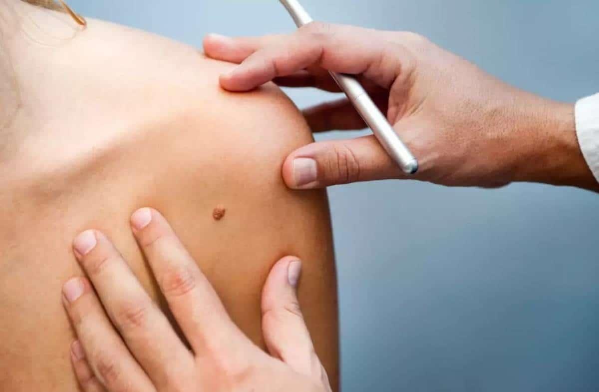 Vacuna contra el cáncer de piel