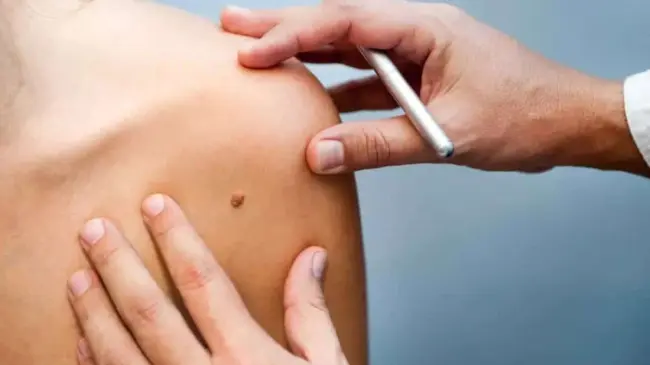 Vacuna contra el cáncer de piel