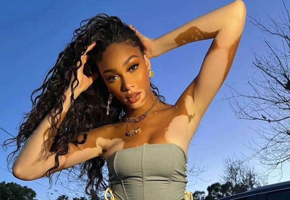 Chantelle Winnie es una modelo canadiense-jamaiquina y portavoz de la enfermedad de la piel llamada vitíligo.