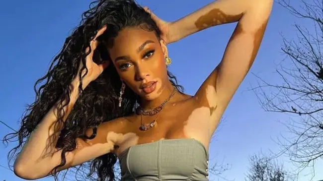 Chantelle Winnie es una modelo canadiense-jamaiquina y portavoz de la enfermedad de la piel llamada vitíligo.