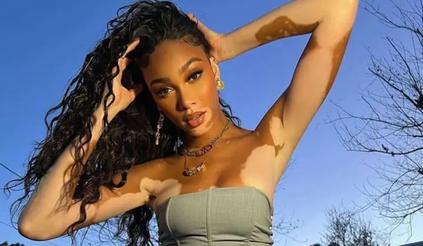 Chantelle Winnie es una modelo canadiense-jamaiquina y portavoz de la enfermedad de la piel llamada vitíligo.