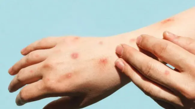 Estos son los principales síntomas del mpox, antes conocida como viruela del mono. Foto: OPS