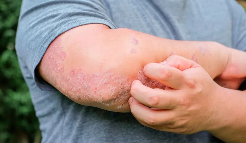 Lanzan campaña nacional para eliminar el estigma en la psoriasis