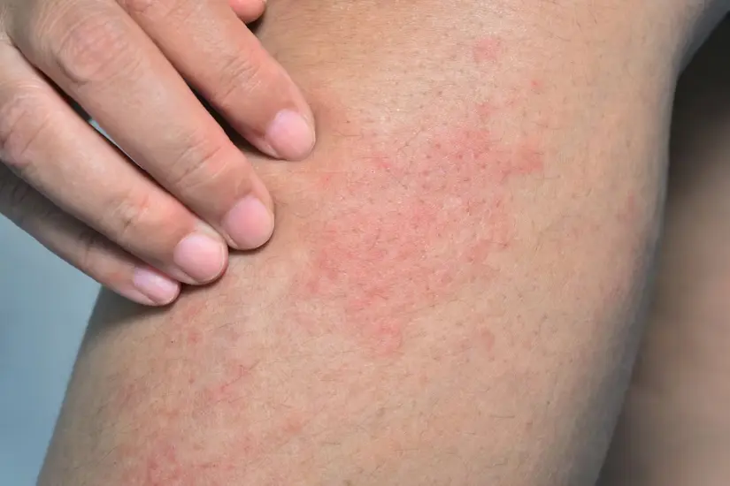 Mantente alerta de los síntomas que genera la picadura del mosco; en caso de agravarse, acude a un médico. Foto: Cortesía.